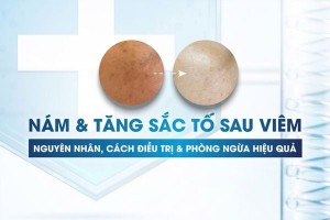 Nám và tăng sắc tố sau Viêm: Nguyên nhân, Cách điều trị và Phòng ngừa hiệu quả
