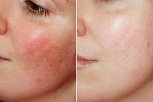 Bí quyết chăm sóc da nhạy, cảm tổn thương: Giải pháp hiệu quả với Azulene 80% & Elazulene Peptablue