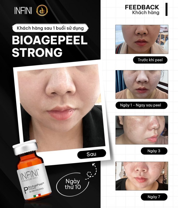 Dung dịch Peel da nám, mụn và cải thiện sẹo rỗ Infini BioAgePeel Strong