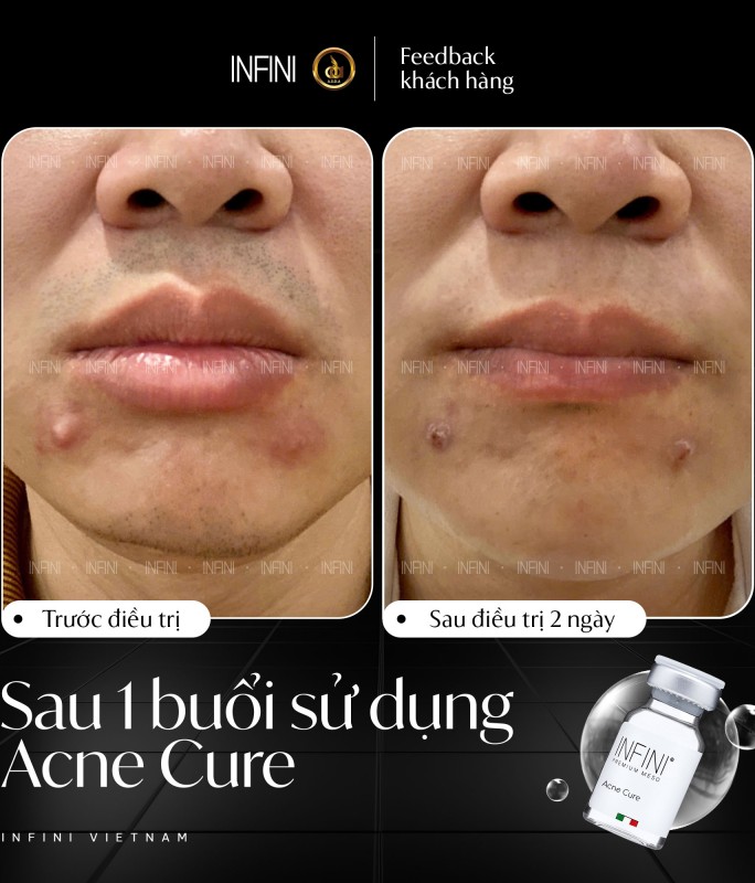 Tinh chất kháng khuẩn, chống viêm, trị mụn Infini Premium Meso AcneCure