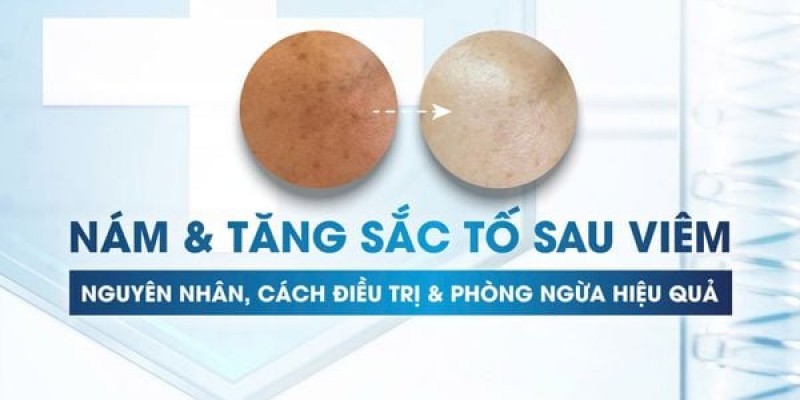 Nám và tăng sắc tố sau Viêm: Nguyên nhân, Cách điều trị và Phòng ngừa hiệu quả